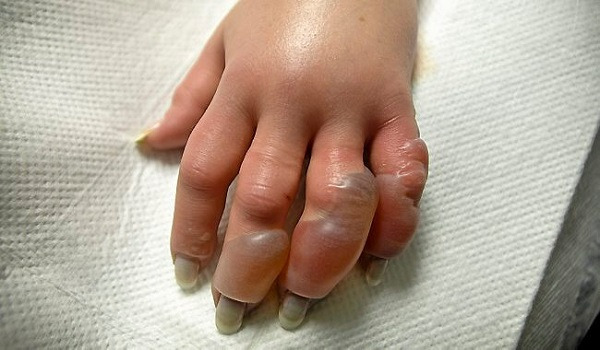 bảo quản đá khô đúng cách tránh bị bỏng lạnh